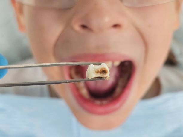 Best Emergency Tooth Extraction in Hometown, PA